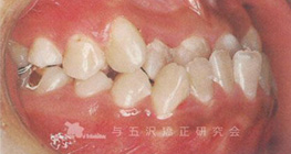 顕著なⅢ級の下突咬合「下顎の回転効果」を有効に使えた症例