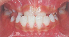 混合歯列期における下突咬合、第一段階治療、第二段階治療、非抜歯で終えた症例