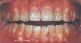 軽度の上突咬合の開咬合、第三大臼歯萌出に伴って開咬合となったと判断された症例