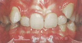 Ⅱ級2類の過蓋咬合、上下顎とも叢生は顕著で顎と歯牙サイズとの間でdiscrepancyが大きい症例