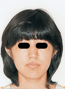 Case photo: Side view, front