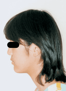 Case photo, side view, left