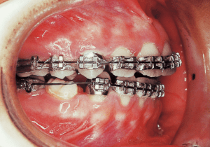 Case photo, side view, right