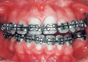 Case photo: Side view, front