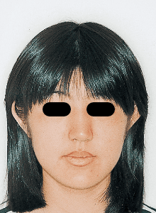 Case photo: Side view, front