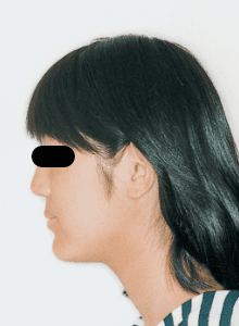 Case photo, side view, left