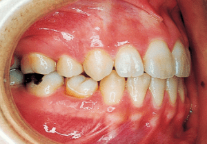 Case photo, side view, right