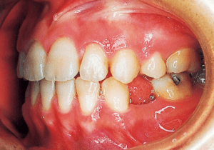 Case photo, side view, left