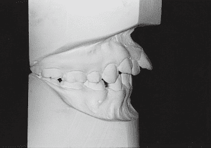 Case photo, side view, right