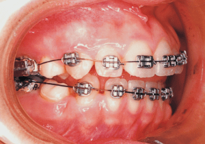 Case photo, side view, right