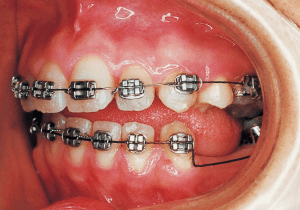 Case photo: Side view, front