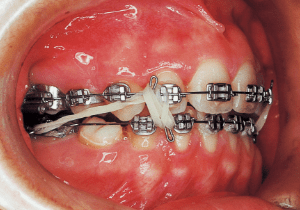 Case photo, side view, right