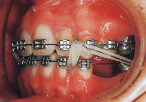 Case photo: Side view, front