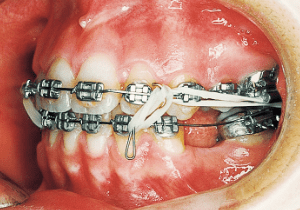 Case photo: Side view, front