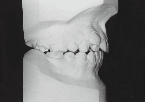 Case photo, side view, right