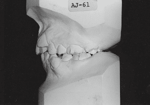 Case photo, side view, left