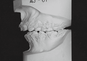 Case photo, side view, left
