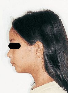 Case photo, side view, left