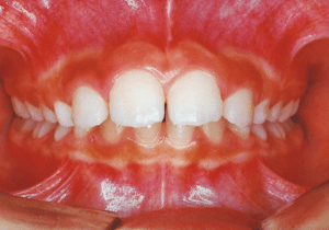 Case photo: Side view, front