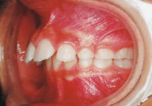 Case photo, side view, left