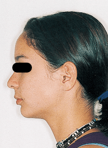 Case photo, side view, left