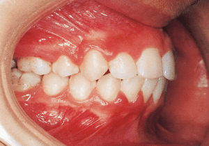 Case photo, side view, right