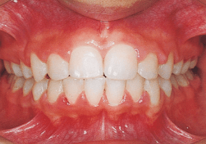 Case photo: Side view, front