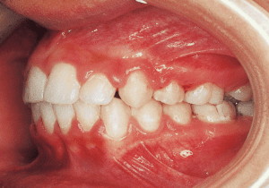 Case photo, side view, left