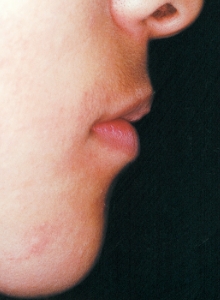 Case photo: Side view, front