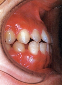 Case photo, side view, left