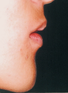 Case photo, side view, right