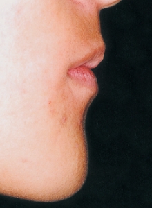 Case photo: Side view, front