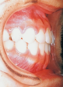 Case photo, side view, left