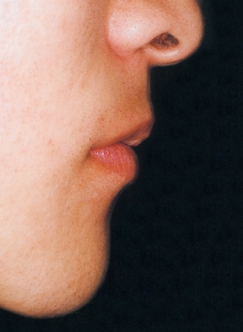 Case photo: Side view, front