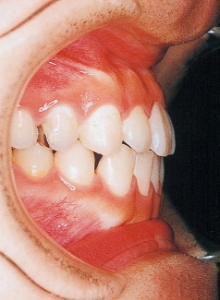 Case photo, side view, left