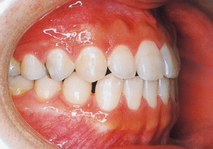 Case photo, side view, right