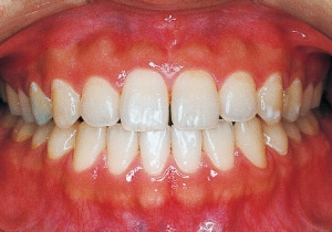 Case photo, side view, right