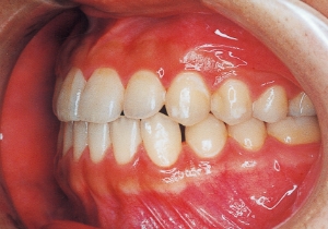 Case photo, side view, right