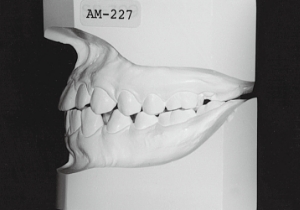 Case photo, side view, left