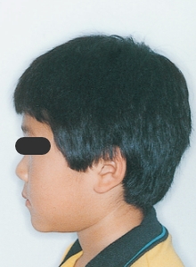 Case photo, side view, left