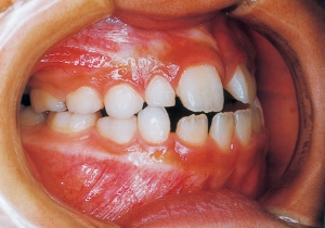 Case photo, side view, right