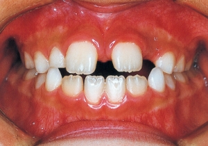 Case photo: Side view, front