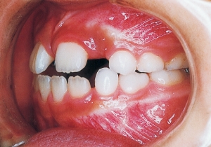 Case photo, side view, left