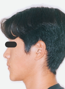 Case photo, side view, left