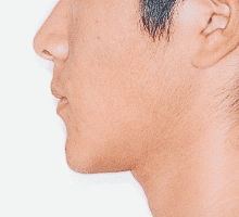 Case photo, side view, left