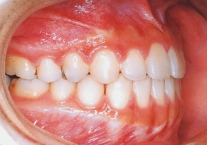 Case photo, side view, right