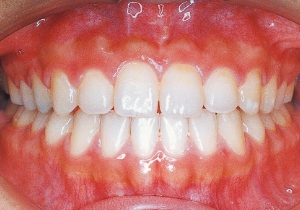 Case photo: Side view, front