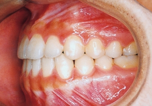 Case photo, side view, left