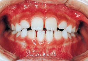 Case photo: Side view, front