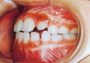 Case photo, side view, left